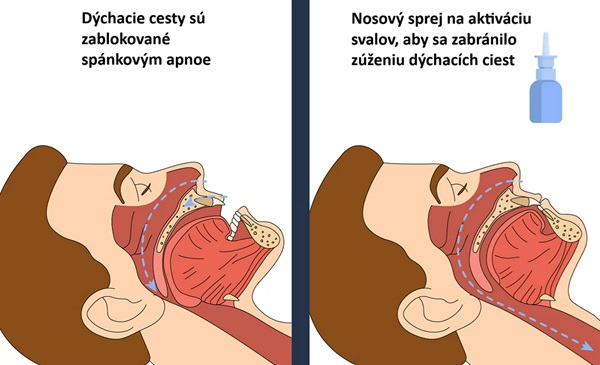 Nosový sprej znížil závažnosť OSA pôsobením na svaly, ktoré udržujú hrdlo a horné dýchacie cesty otvorené.