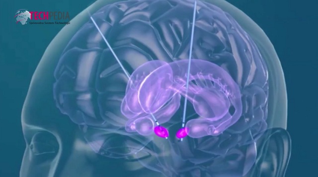 Hĺbková stimulácia mozgu výrazne redukuje trasenie a poruchy motoriky pacientov