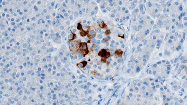 Tím výskumníkov z Fínska po identifikácii enterovírusov v pankreatickom tkanive (na obrázku v hnedej farbe) vyvinul vkacínu, ktorá by mohla zabrániť rozvoju cukrovky typu 1.